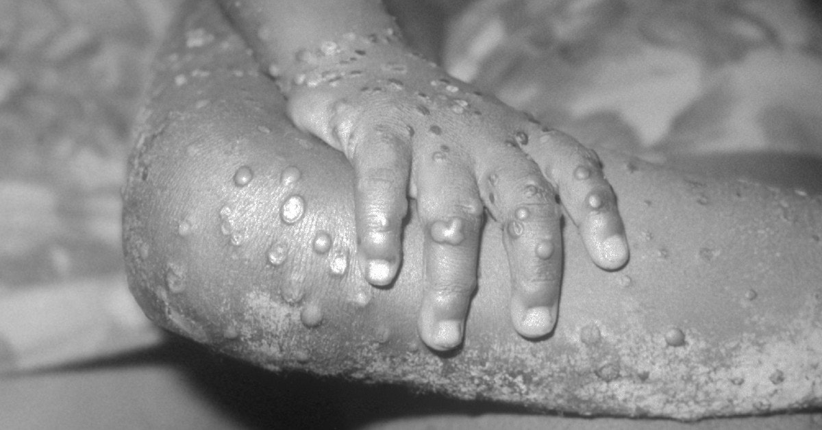 Boy became the first victim of monkey pox