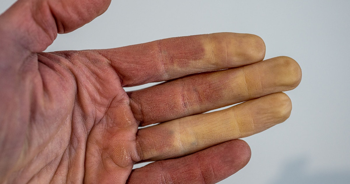 Raynauds syndrom: Därför blir tår och fingrar vita | iform.se