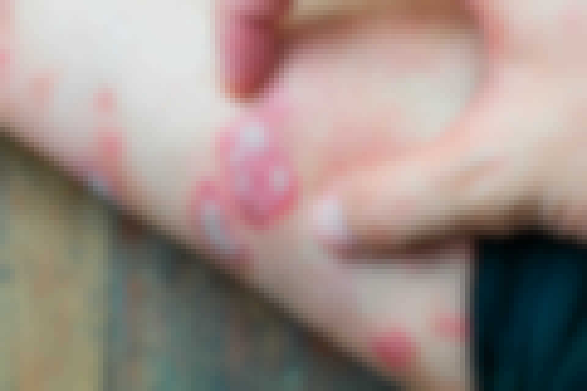 psoriasis top