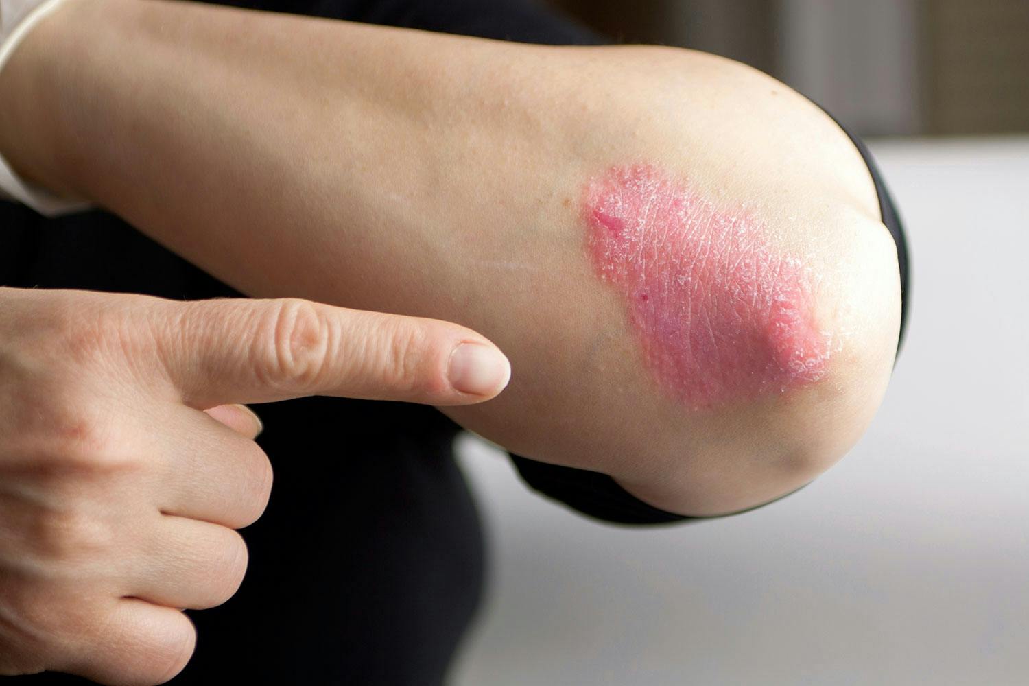 Psoriasis Psoriasis