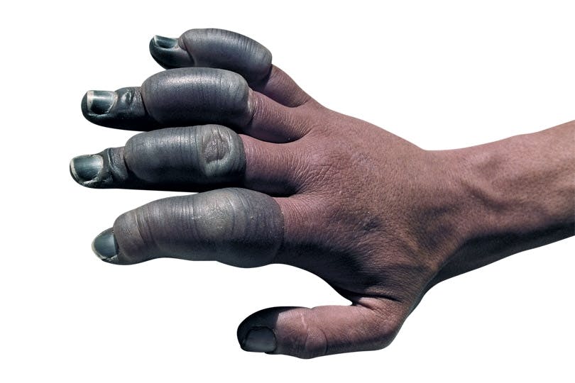 Frozen hand Frozen hand