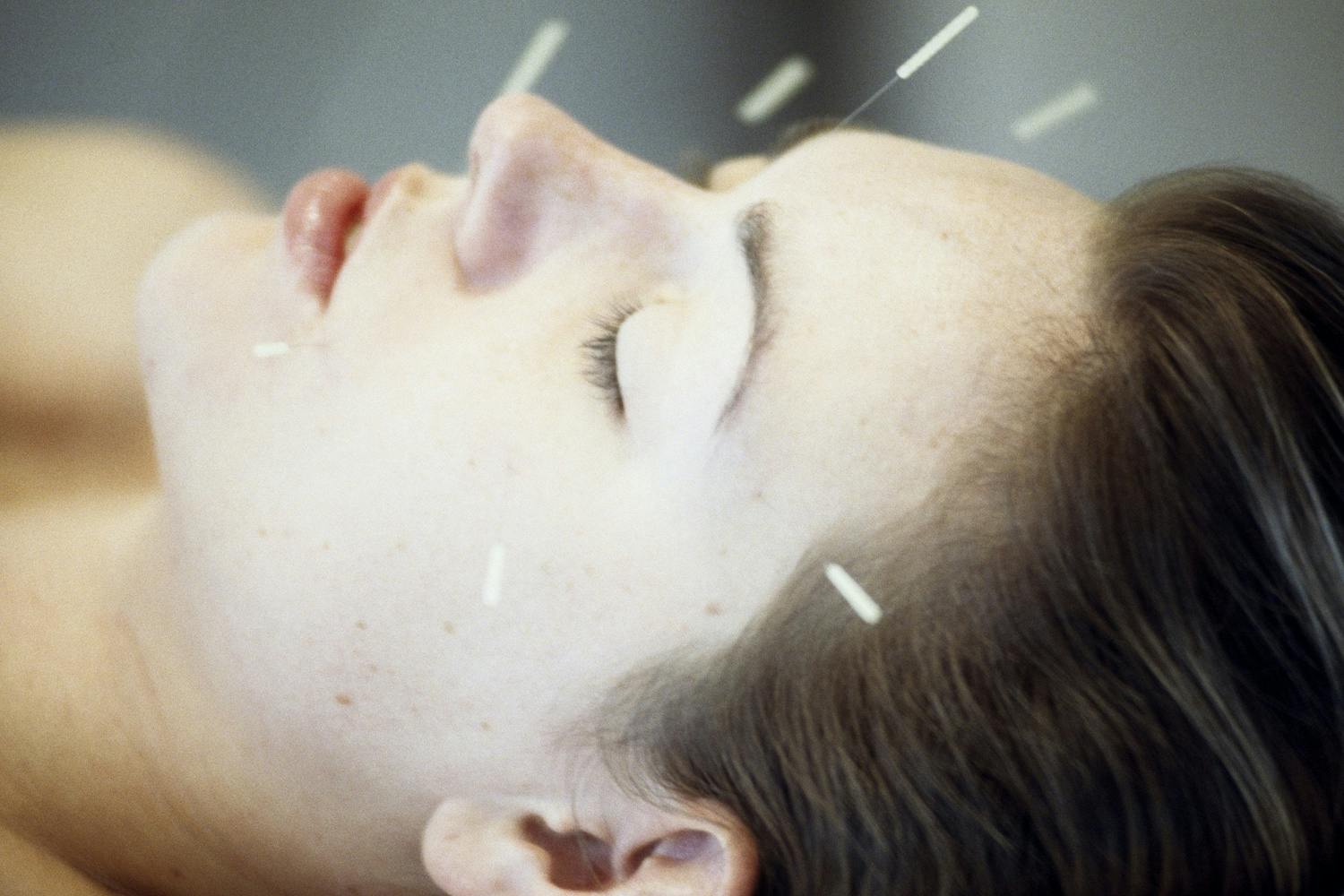 Woman with acupunctur needles Woman with acupunctur needles