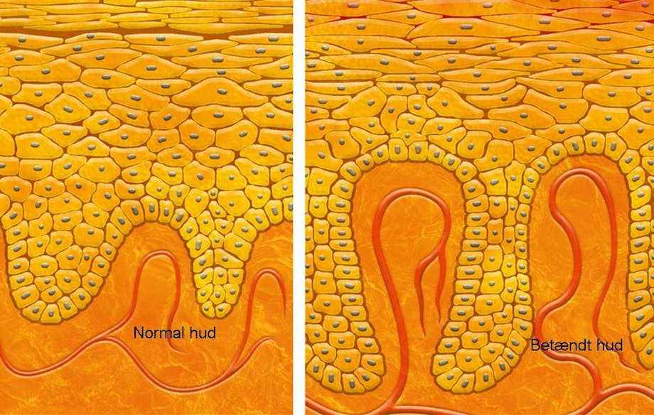 Psoriasis Psoriasis