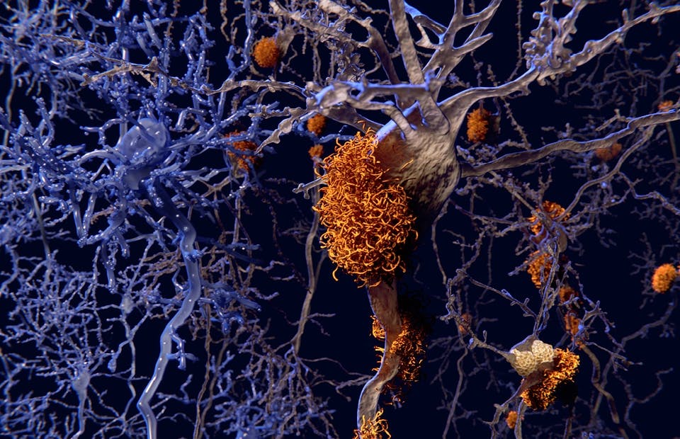 alzheimer alzheimer