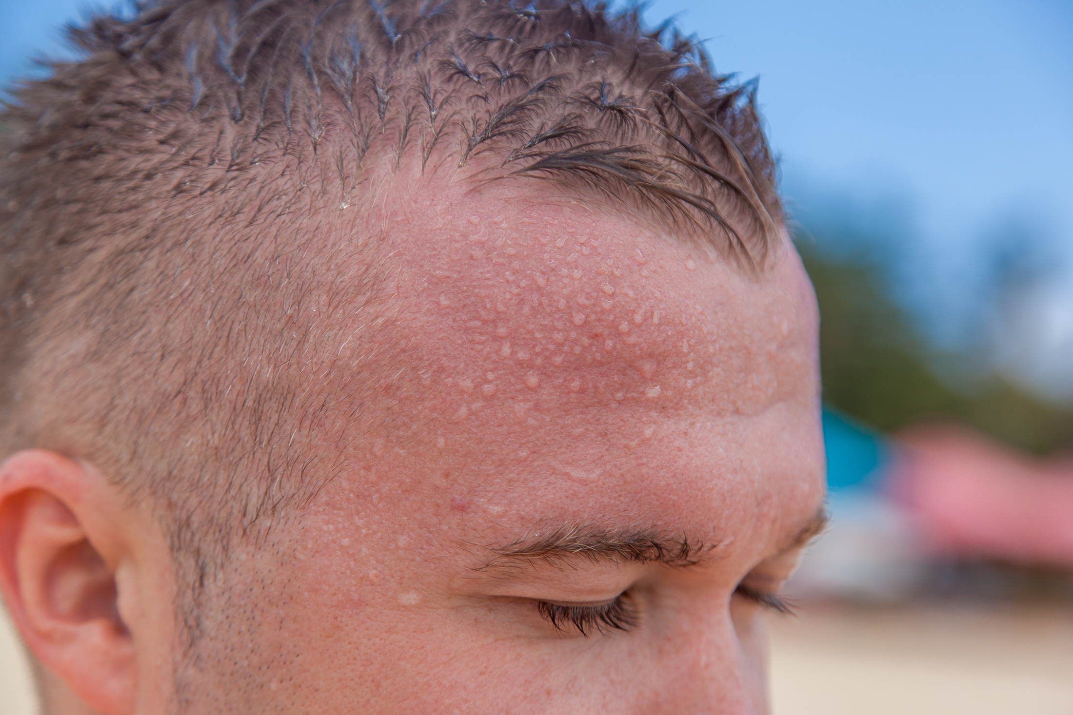 Sådan undgår du hedeslag