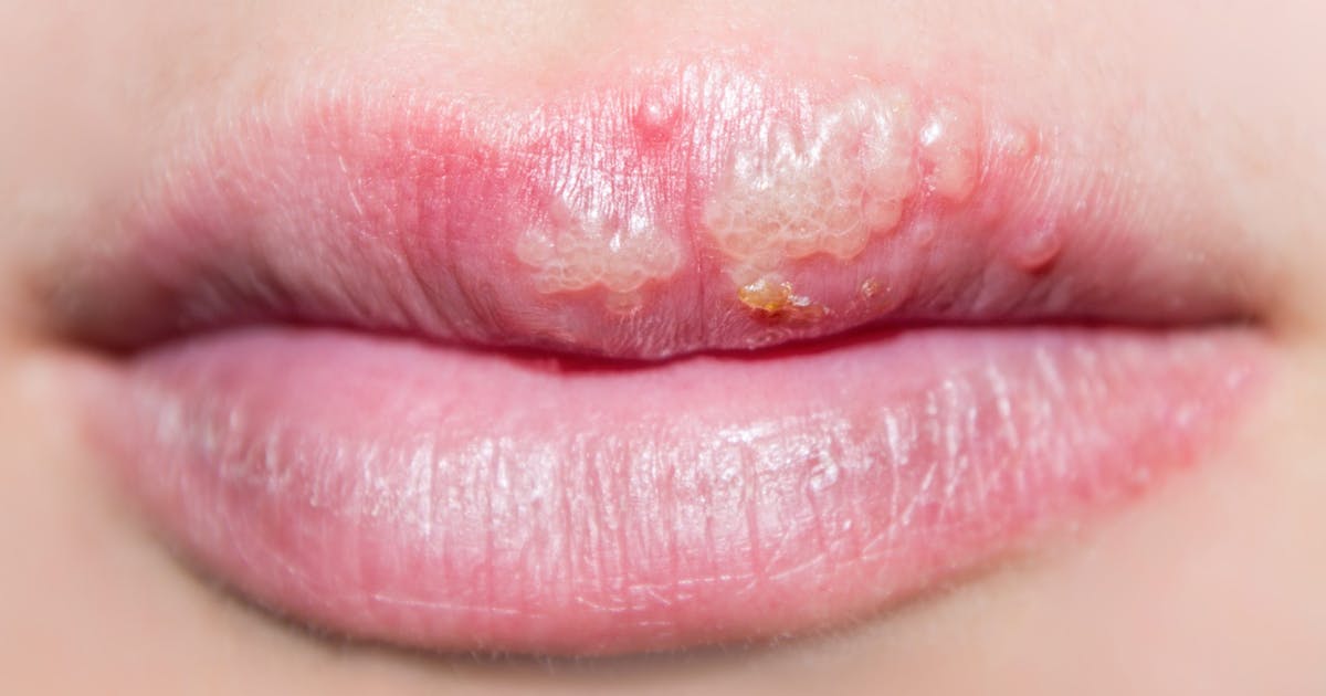 Herpes Den Udbredte Konssygdom Skal Stoppes Med En Vaccine Illvid Dk