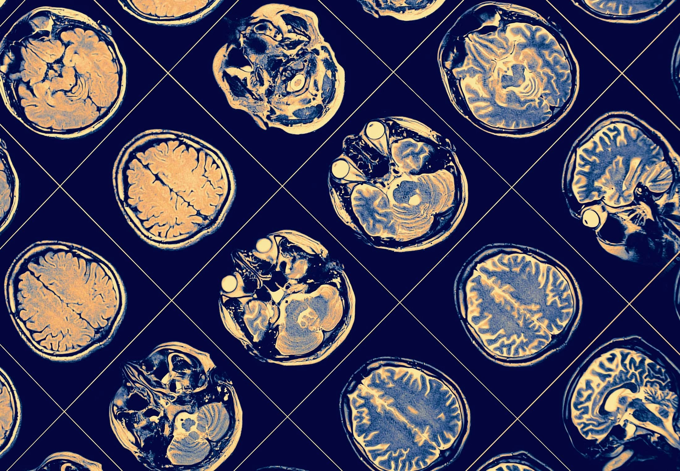 Hvad er hjernerystelse og er det farligt for hjernen? illvid.dk