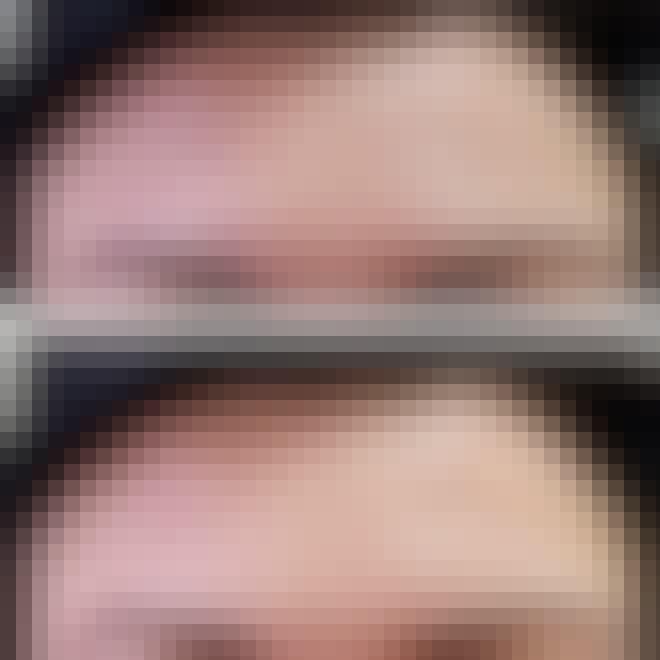 Botox ennen ja jälkeen Botox ennen ja jälkeen