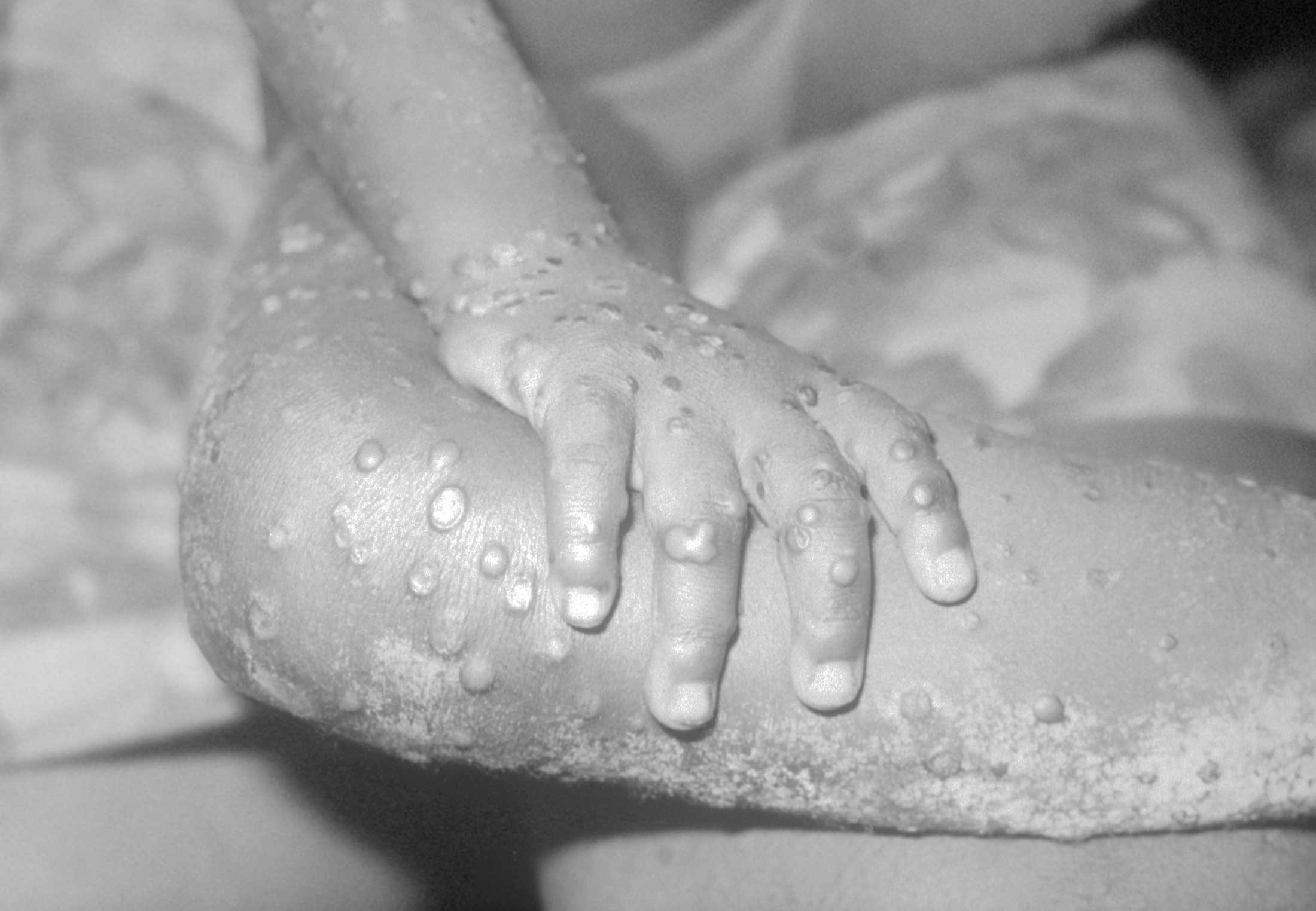 Monkeypox – Overview of Symptoms and Spread