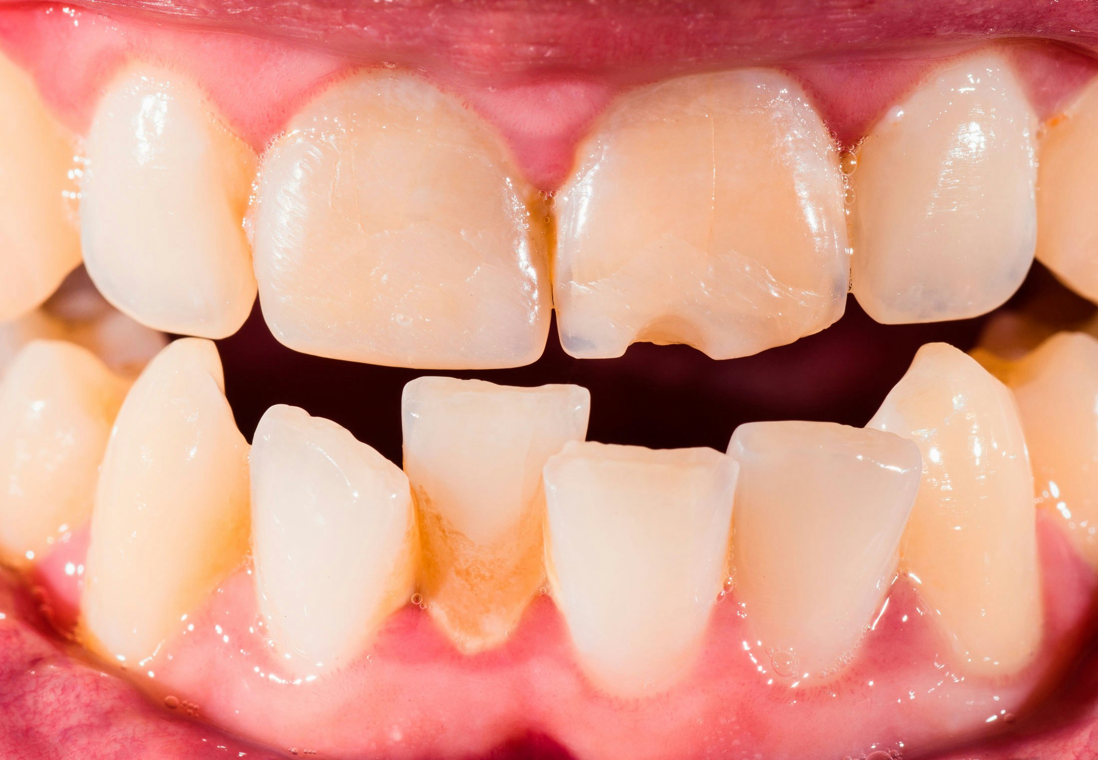 Gingivitis can lead to serious diseases TIme News