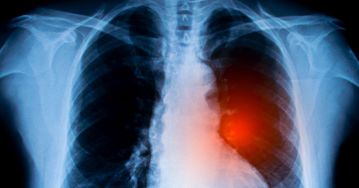 Gli scienziati trovano una nuova arma contro il cancro polmonare aggressivo Gli scienziati trovano una nuova arma contro il cancro polmonare aggressivo