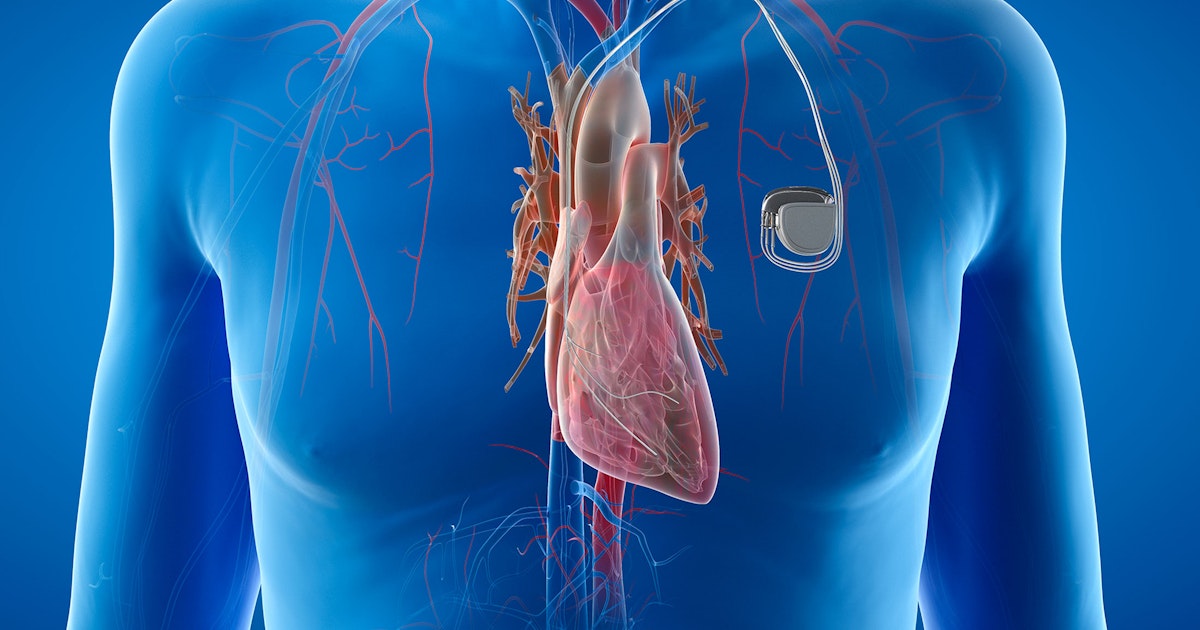 Researchers are developing a pacemaker that does not require a battery ...