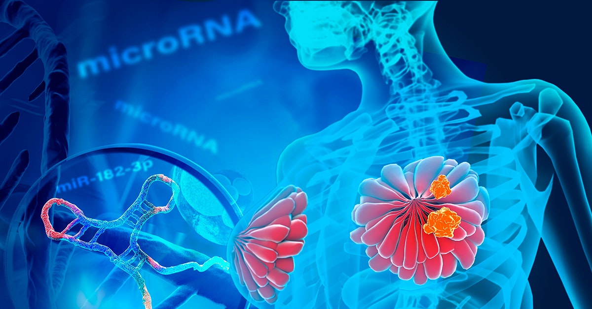 Gli scienziati potrebbero scoprire come si diffonde il cancro al seno Gli scienziati potrebbero scoprire come si diffonde il cancro al seno